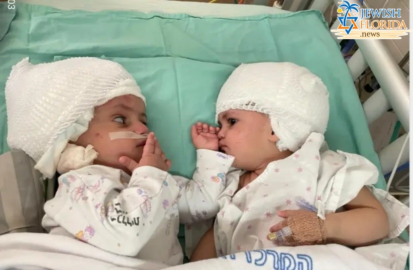 Israeli first: Doctors separate heads of one-year-old conjoined twins