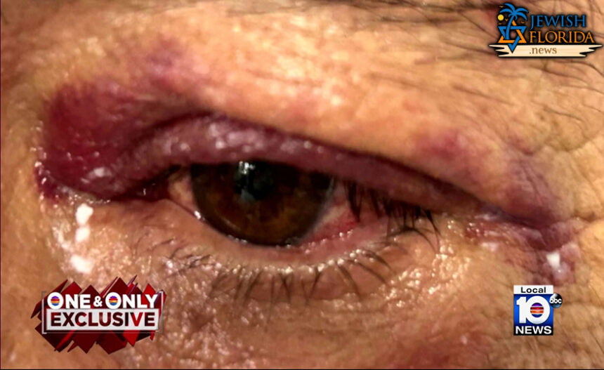 Elderly victim speaks out after being attacked near Lauderhill synagogue